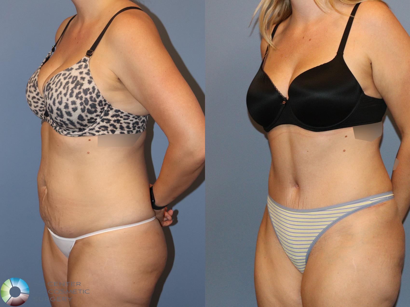 Before & After Tummy Tuck Case 12170 Left Oblique in Denver and Colorado Springs, CO