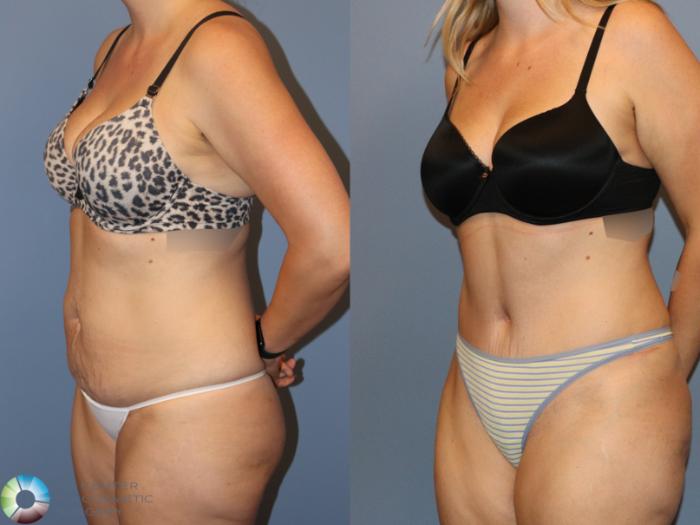 Before & After Tummy Tuck Case 12170 Left Oblique in Denver and Colorado Springs, CO