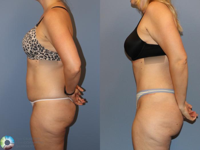 Before & After Tummy Tuck Case 12170 Left Side in Denver and Colorado Springs, CO