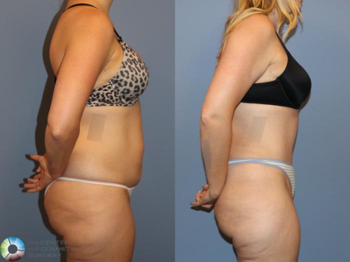 Before & After Tummy Tuck Case 12170 Right Side in Denver and Colorado Springs, CO