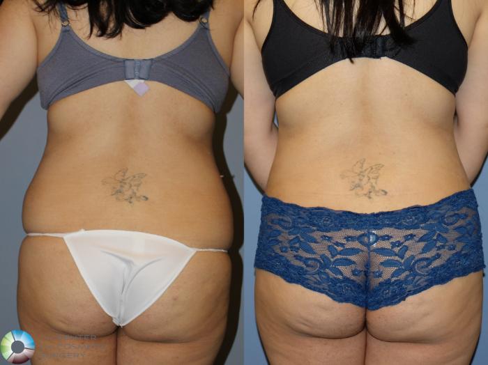 Before & After Power-Assisted Liposuction Case 12173 Back in Denver and Colorado Springs, CO