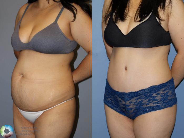 Before & After Power-Assisted Liposuction Case 12173 Left Oblique in Denver and Colorado Springs, CO