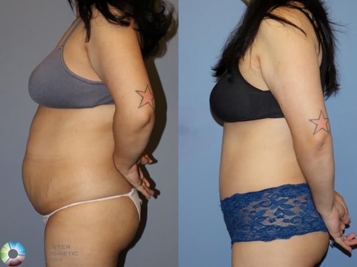 Before & After Power-Assisted Liposuction Case 12173 Left Side in Denver and Colorado Springs, CO