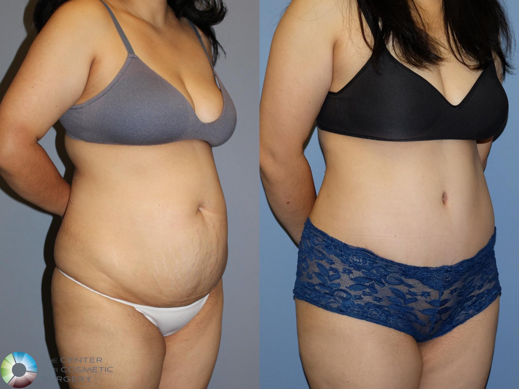 Before & After Tummy Tuck Case 12173 Right Oblique in Denver and Colorado Springs, CO