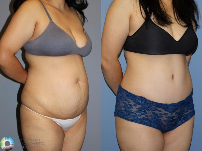 Before & After Power-Assisted Liposuction Case 12173 Right Oblique in Denver and Colorado Springs, CO