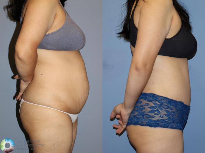 Before & After Power-Assisted Liposuction Case 12173 Right Side in Denver and Colorado Springs, CO