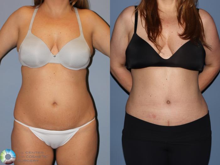 Before & After Power-Assisted Liposuction Case 12185 Front in Denver and Colorado Springs, CO
