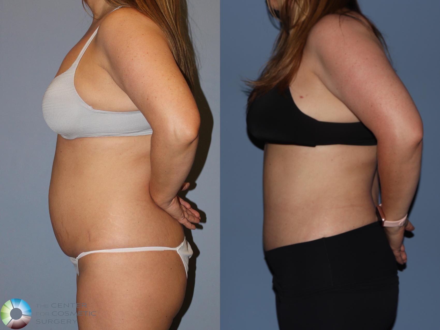 Before & After Tummy Tuck Case 12185 Left Side in Denver and Colorado Springs, CO