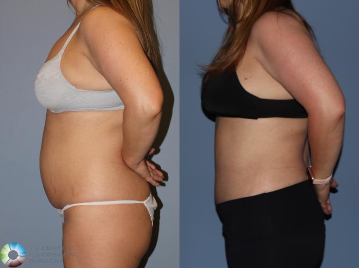 Before & After Power-Assisted Liposuction Case 12185 Left Side in Denver and Colorado Springs, CO