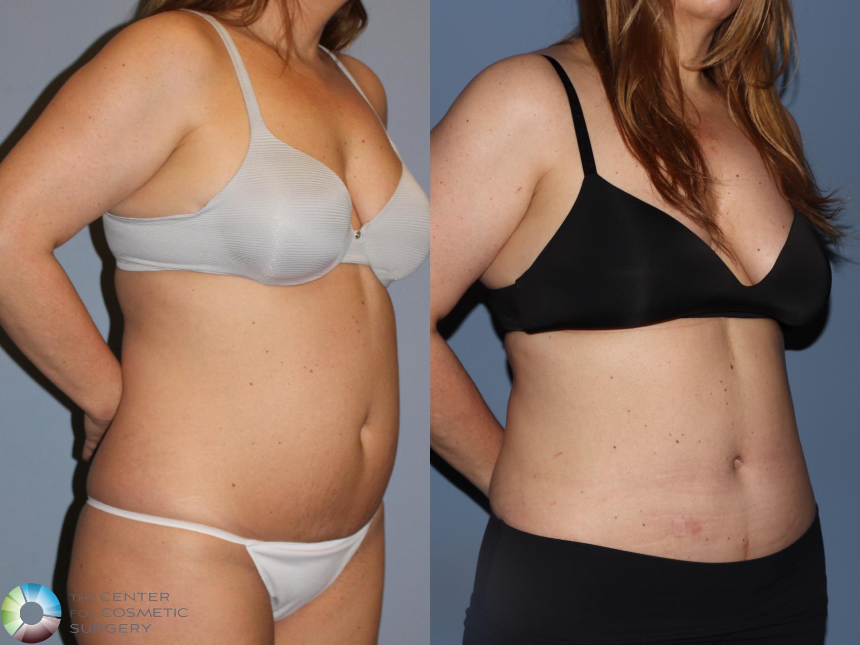 Before & After Tummy Tuck Case 12185 Right Oblique in Denver and Colorado Springs, CO