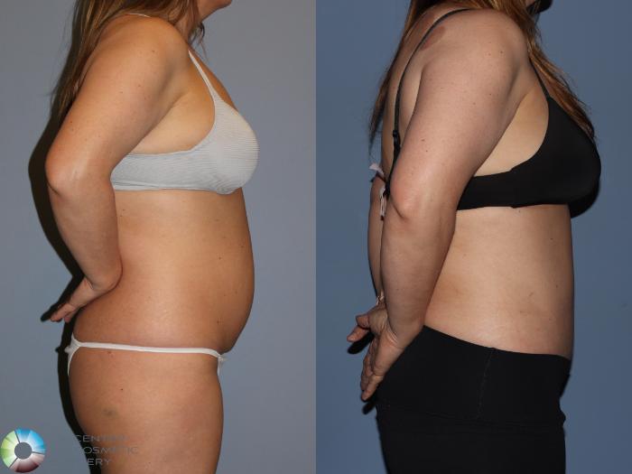 Before & After Power-Assisted Liposuction Case 12185 Right Side in Denver and Colorado Springs, CO