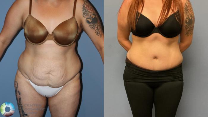Before & After Tummy Tuck Case 12226 Front in Denver and Colorado Springs, CO