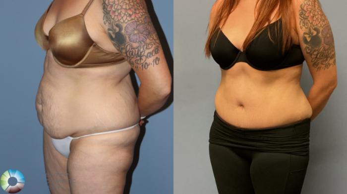 Before & After Tummy Tuck Case 12226 Left Oblique in Denver and Colorado Springs, CO