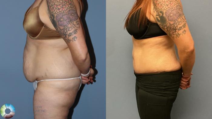 Before & After Tummy Tuck Case 12226 Left Side in Denver and Colorado Springs, CO
