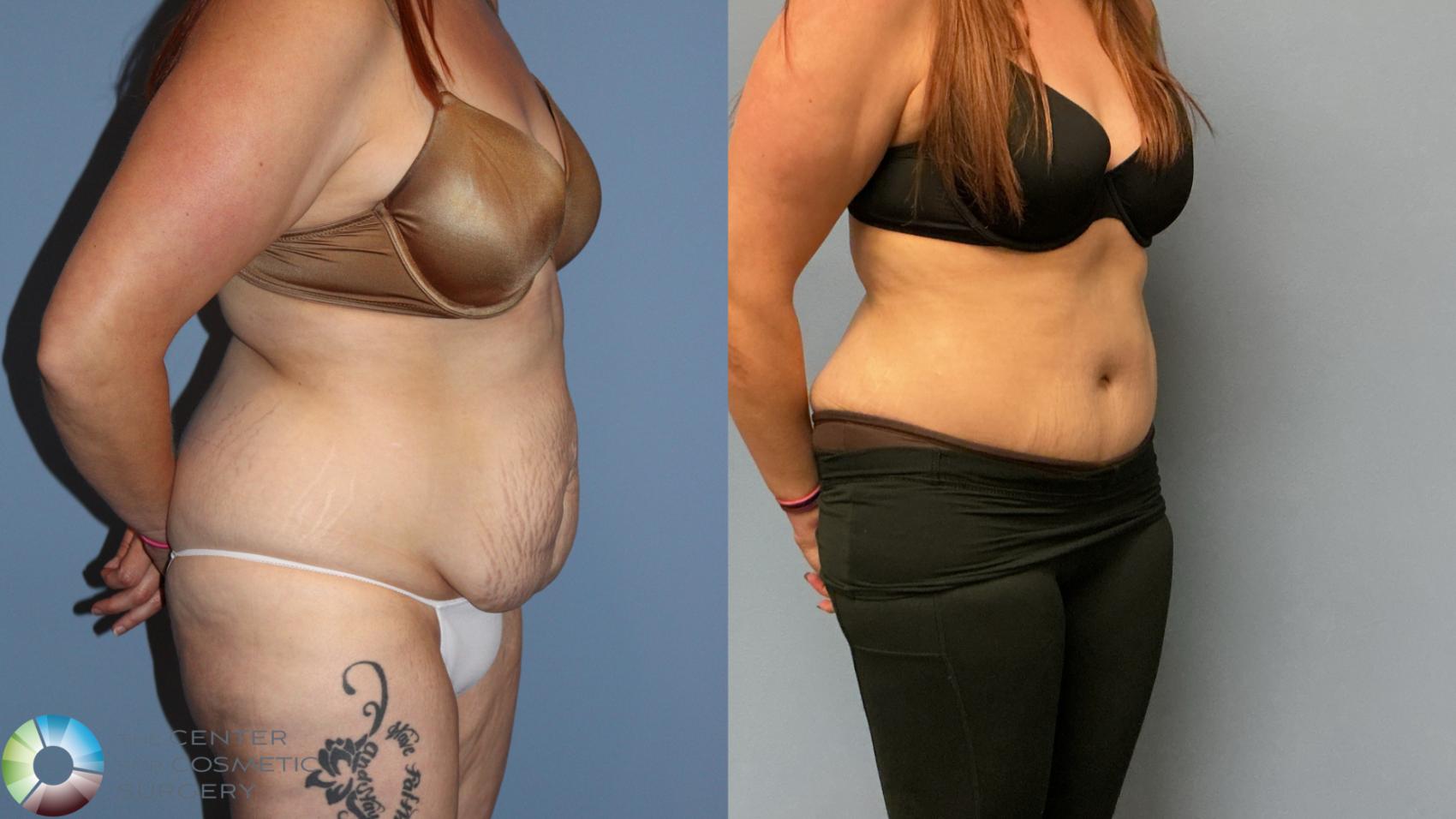 Before & After Tummy Tuck Case 12226 Right Oblique in Denver and Colorado Springs, CO