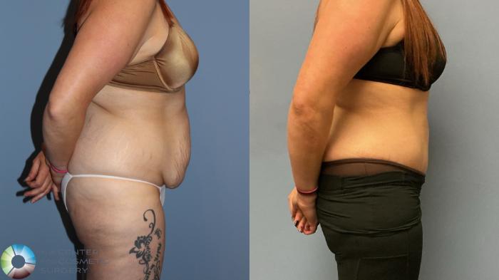 Before & After Tummy Tuck Case 12226 Right Side in Denver and Colorado Springs, CO