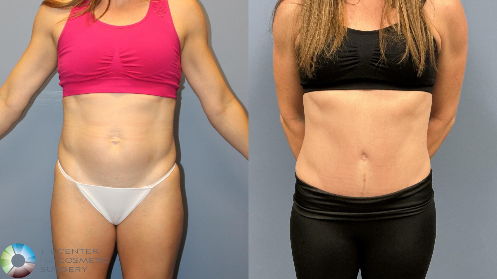 Before & After Tummy Tuck Case 12227 Front in Denver and Colorado Springs, CO