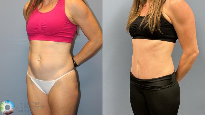 Before & After Tummy Tuck Case 12227 Left Oblique in Denver and Colorado Springs, CO