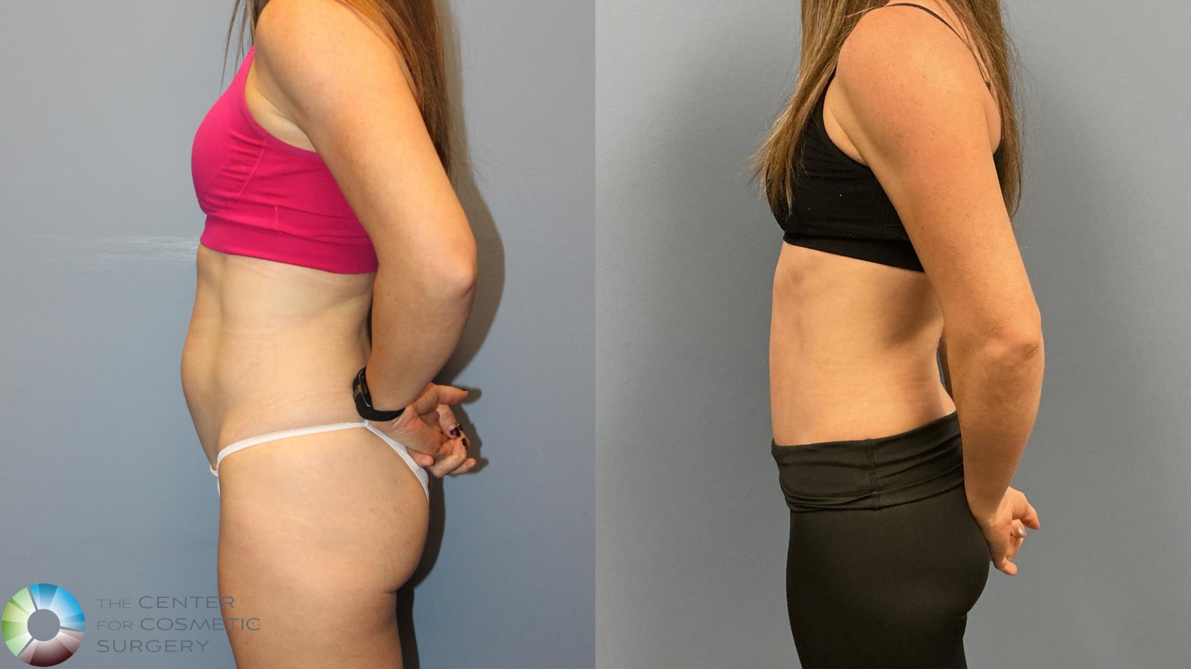 Before & After Tummy Tuck Case 12227 Left Side in Denver and Colorado Springs, CO