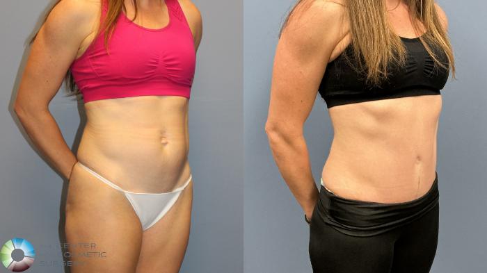 Before & After Tummy Tuck Case 12227 Right Oblique in Denver and Colorado Springs, CO
