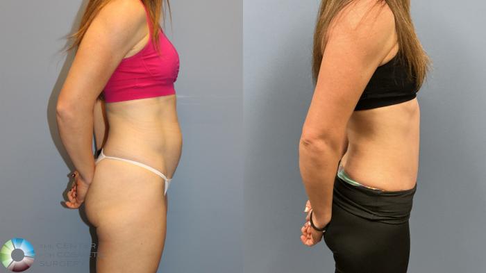 Before & After Tummy Tuck Case 12227 Right Side in Denver and Colorado Springs, CO