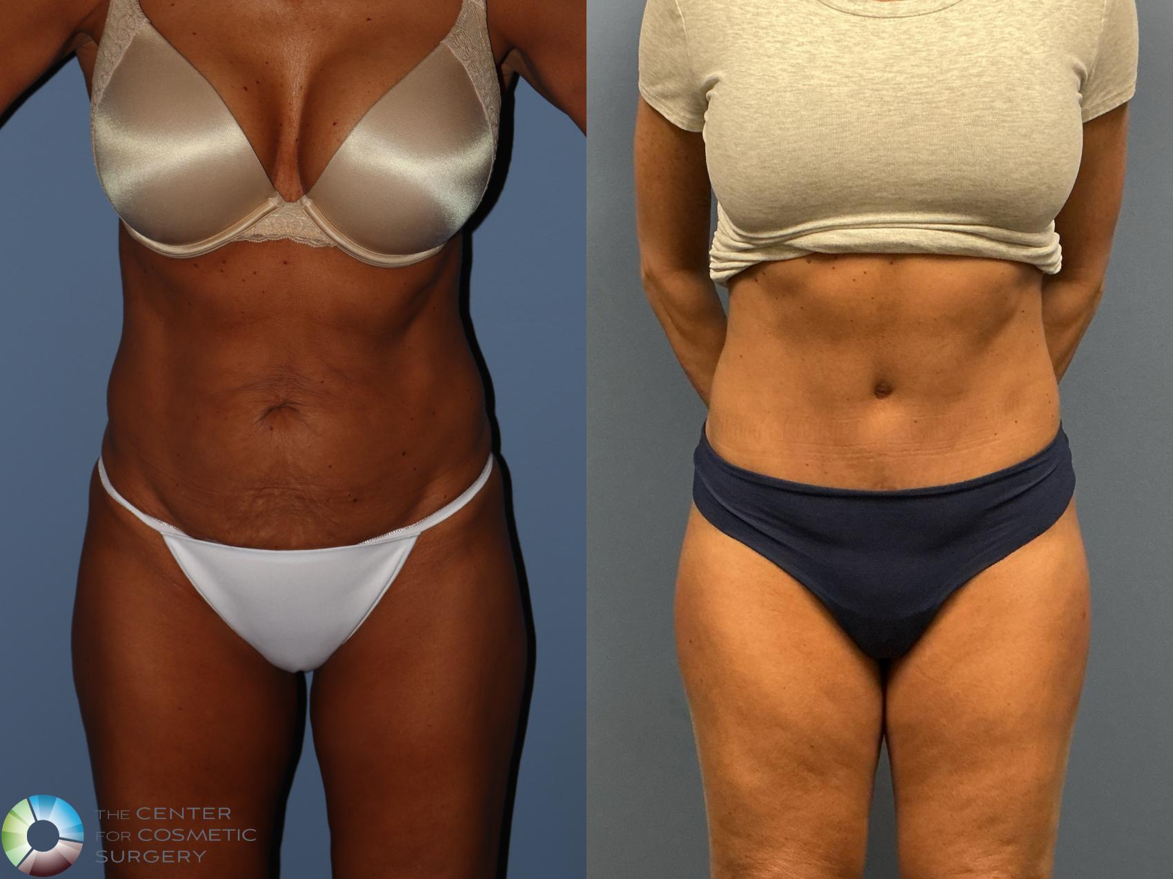 Before & After Tummy Tuck Case 12228 Front in Denver and Colorado Springs, CO