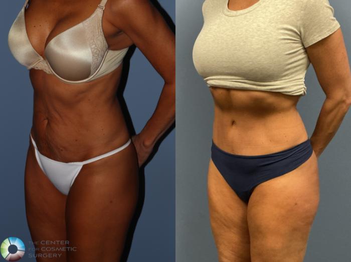 Before & After Tummy Tuck Case 12228 Left Oblique in Denver and Colorado Springs, CO
