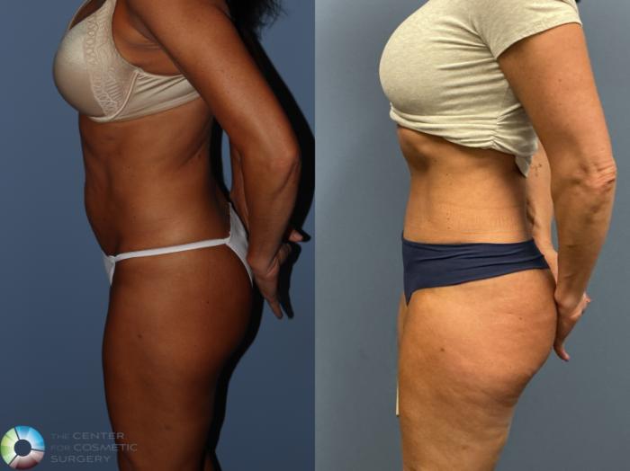 Before & After Tummy Tuck Case 12228 Left Side in Denver and Colorado Springs, CO