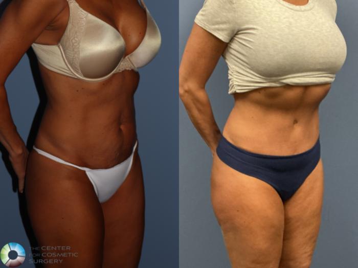 Before & After Tummy Tuck Case 12228 Right Oblique in Denver and Colorado Springs, CO