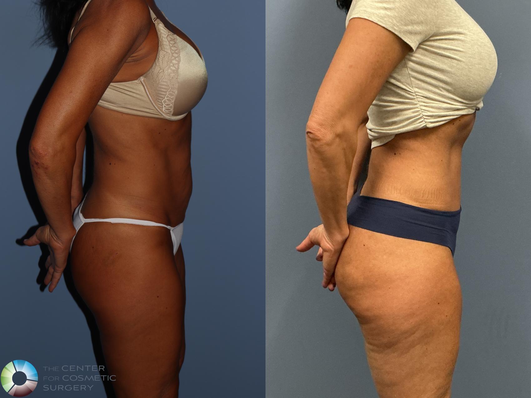 Before & After Tummy Tuck Case 12228 Right Side in Denver and Colorado Springs, CO