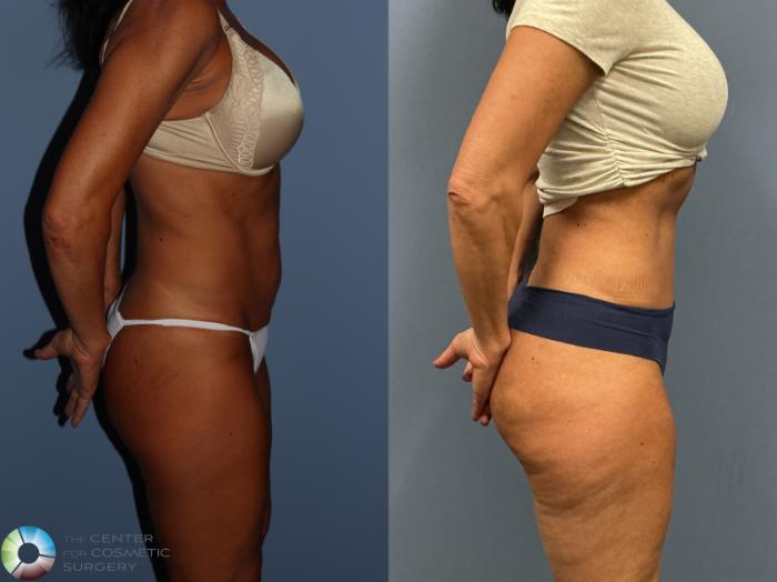 Before & After Tummy Tuck Case 12228 Right Side in Denver and Colorado Springs, CO