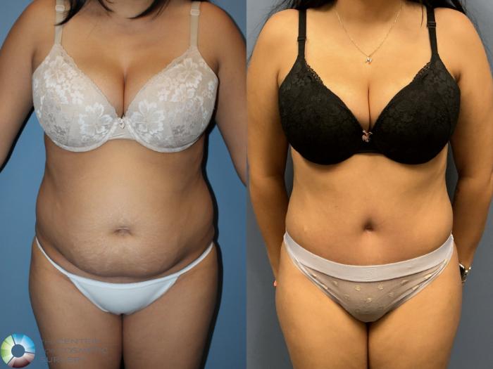 Before & After Power-Assisted Liposuction Case 12235 Front in Denver and Colorado Springs, CO