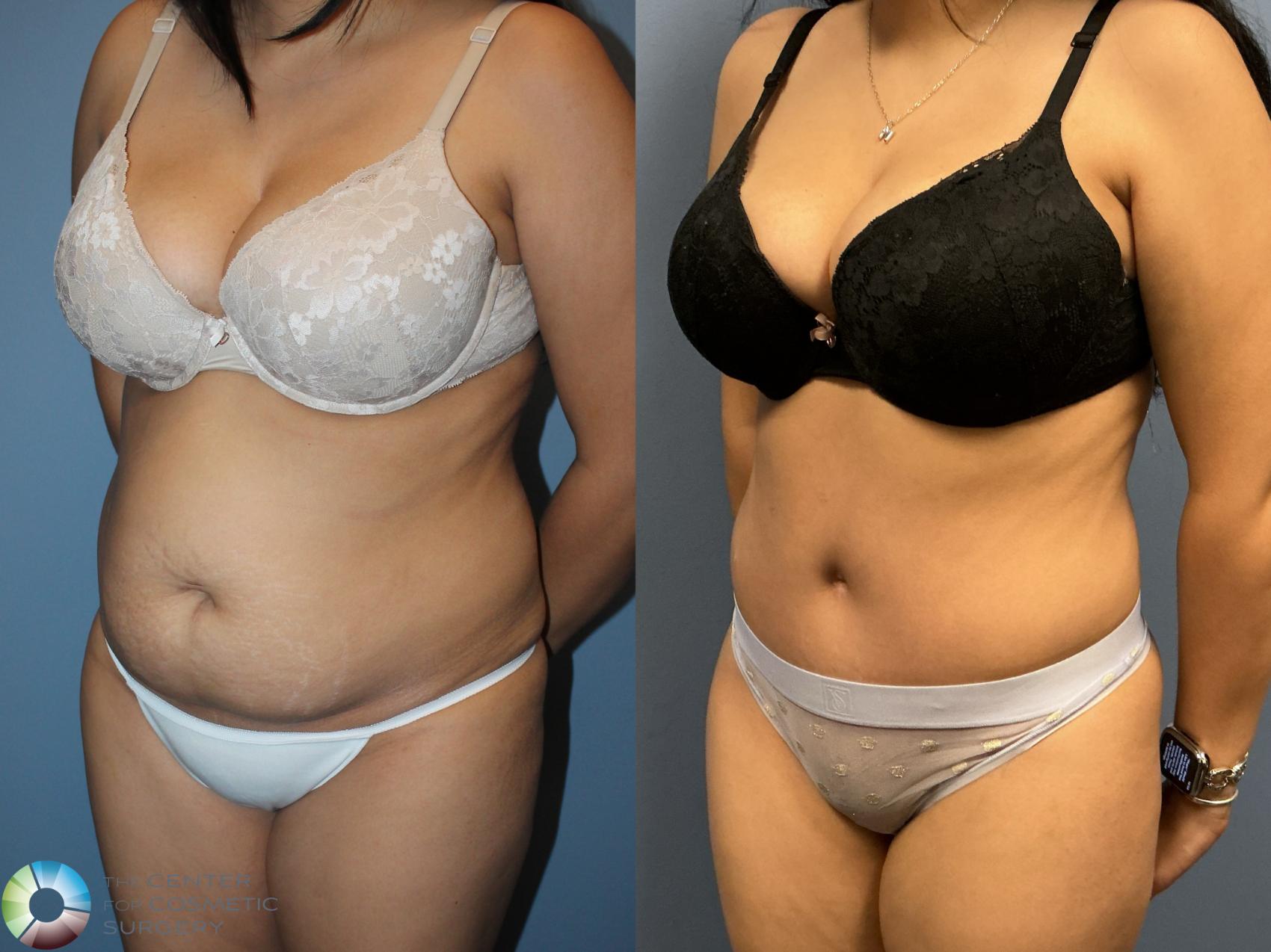 Before & After Tummy Tuck Case 12235 Left Oblique in Denver and Colorado Springs, CO