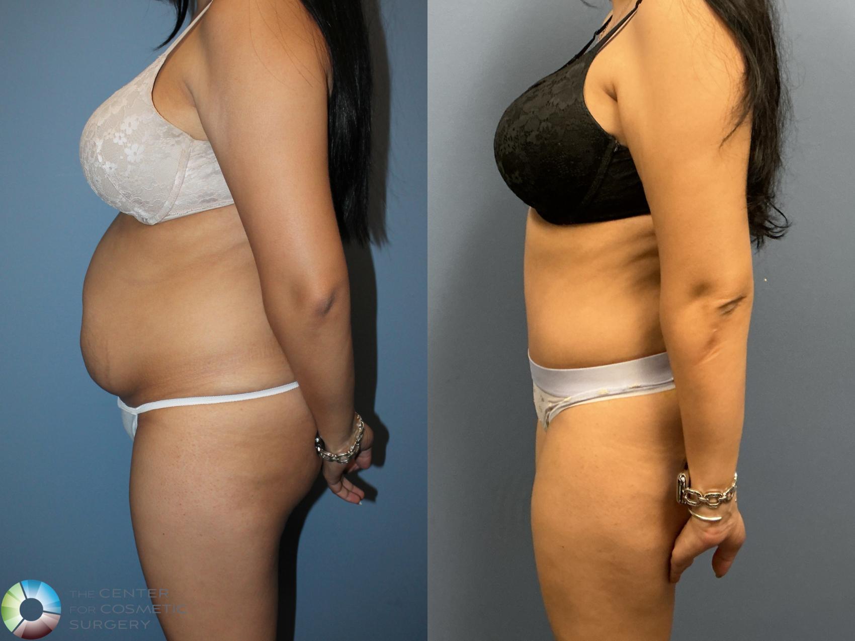 Before & After Tummy Tuck Case 12235 Left Side in Denver and Colorado Springs, CO