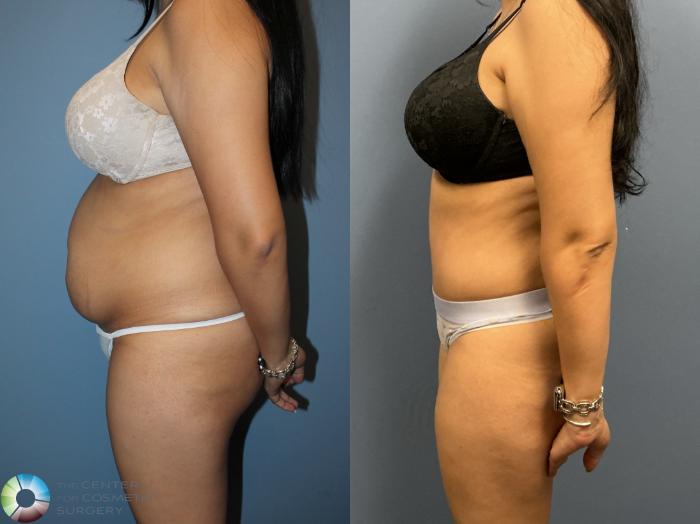 Before & After Power-Assisted Liposuction Case 12235 Left Side in Denver and Colorado Springs, CO
