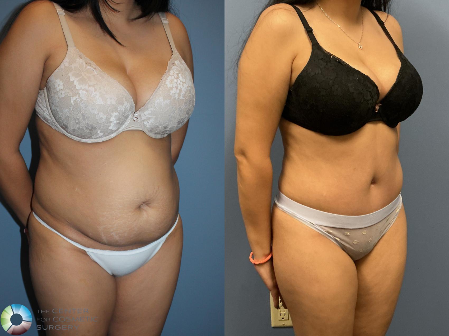 Before & After Tummy Tuck Case 12235 Right Oblique in Denver and Colorado Springs, CO