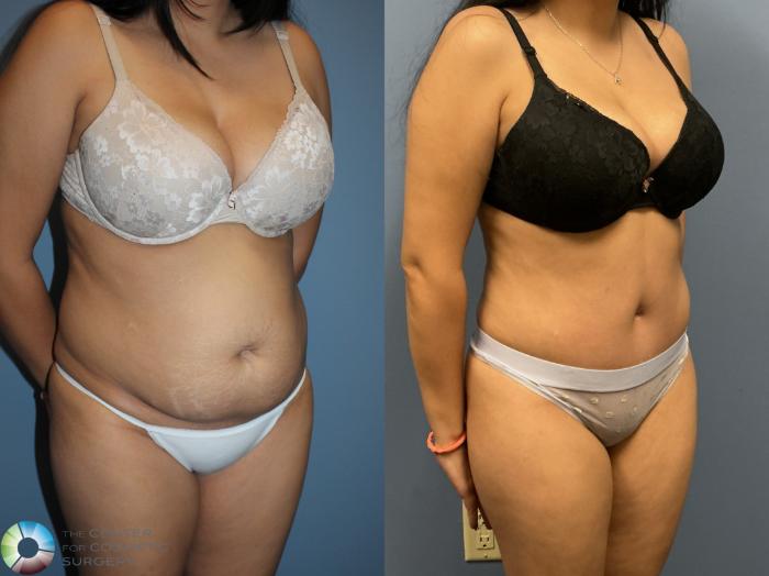 Before & After Power-Assisted Liposuction Case 12235 Right Oblique in Denver and Colorado Springs, CO