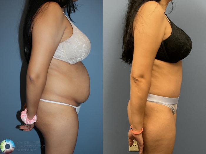Before & After Power-Assisted Liposuction Case 12235 Right Side in Denver and Colorado Springs, CO