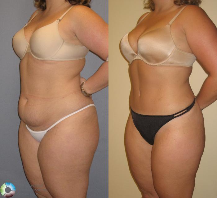Before & After Tummy Tuck Case 142 View #2 View in Golden, CO