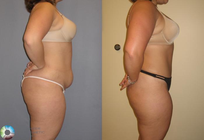 Before & After Tummy Tuck Case 142 View #3 View in Golden, CO