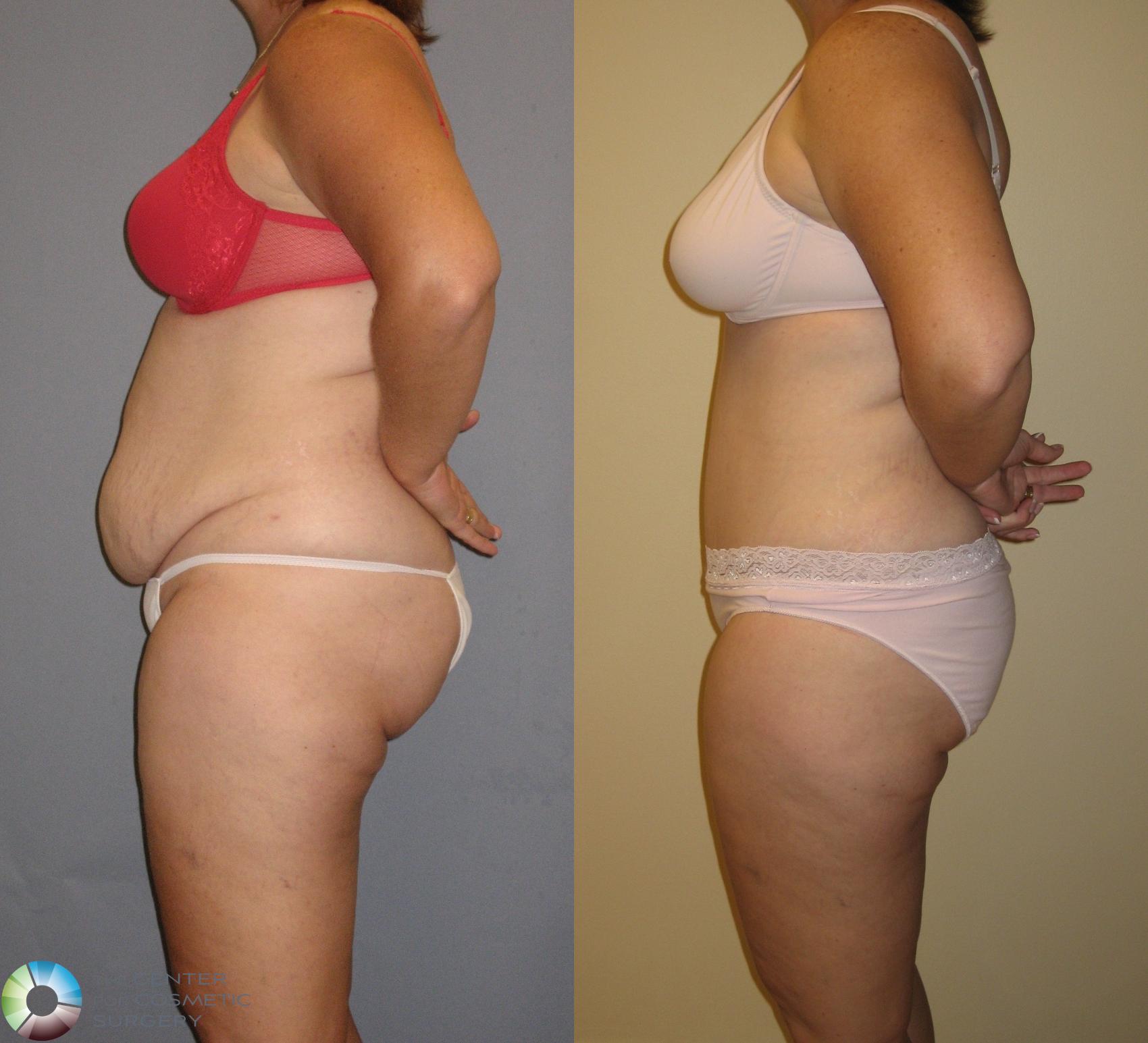 Before & After Tummy Tuck Case 145 View #1 in Denver and Colorado Springs, CO