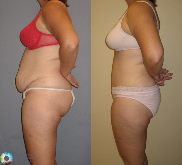 Before & After Tummy Tuck Case 145 View #1 View in Golden, CO