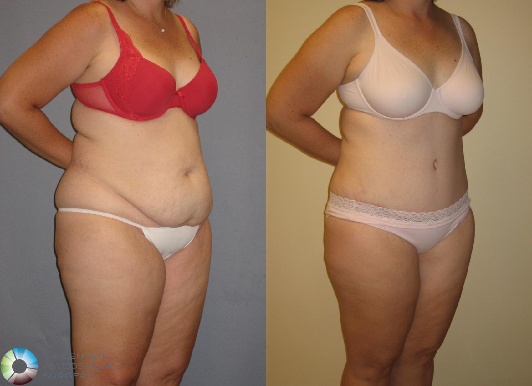 Before & After Tummy Tuck Case 145 View #2 in Denver and Colorado Springs, CO