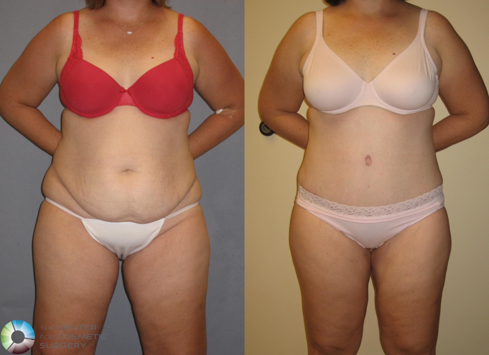 Before & After Tummy Tuck Case 145 View #3 in Denver and Colorado Springs, CO