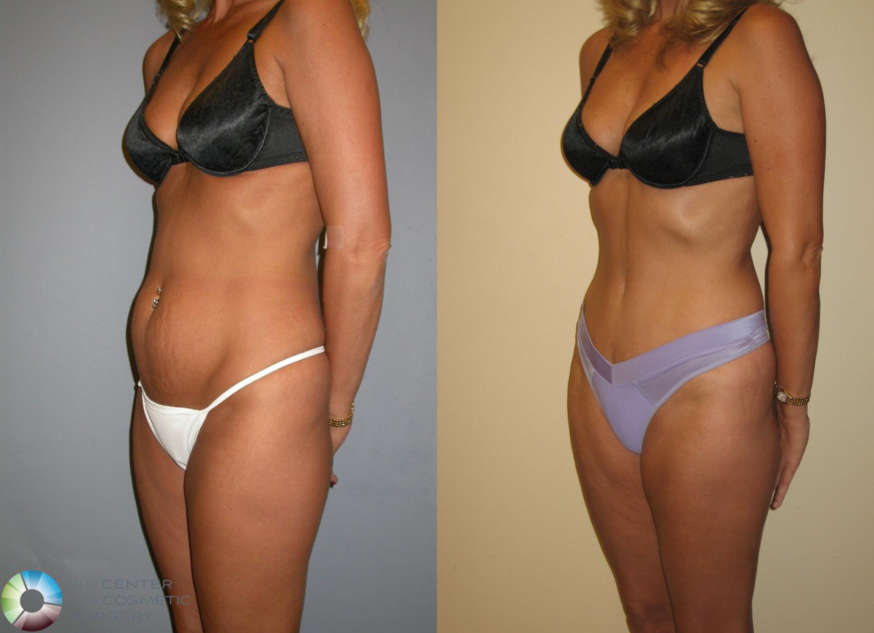 Tummy Tuck Before and After Pictures Case 11390, Denver, CO