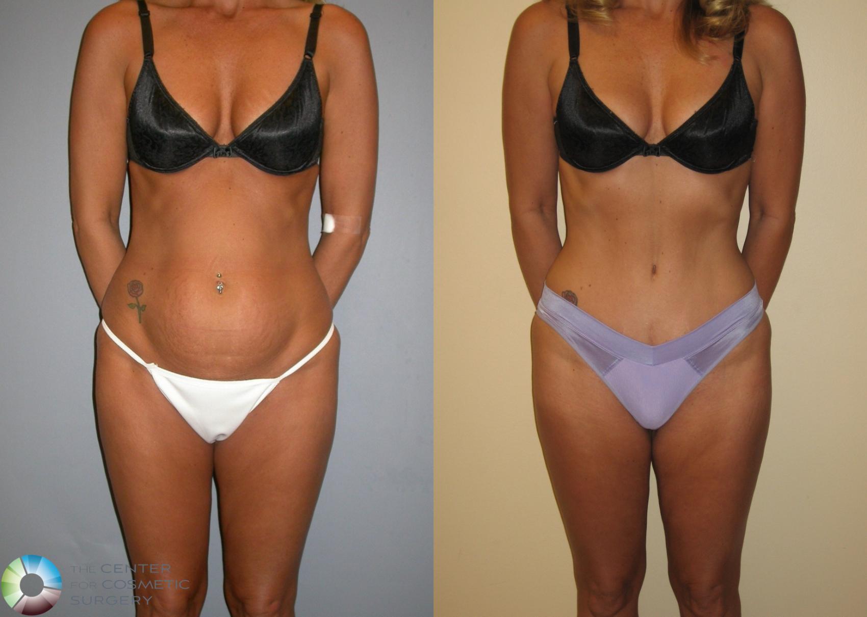 Before & After Tummy Tuck Case 146 View #2 View in Golden, CO