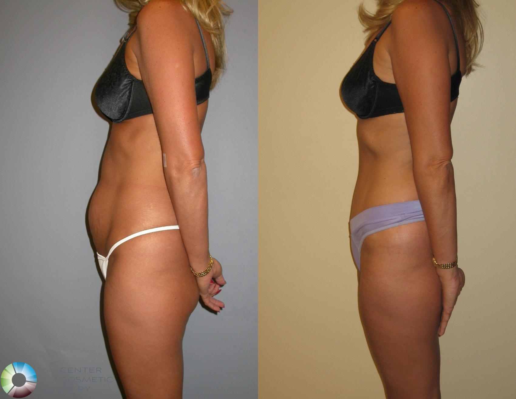 Before & After Tummy Tuck Case 146 View #3 View in Golden, CO