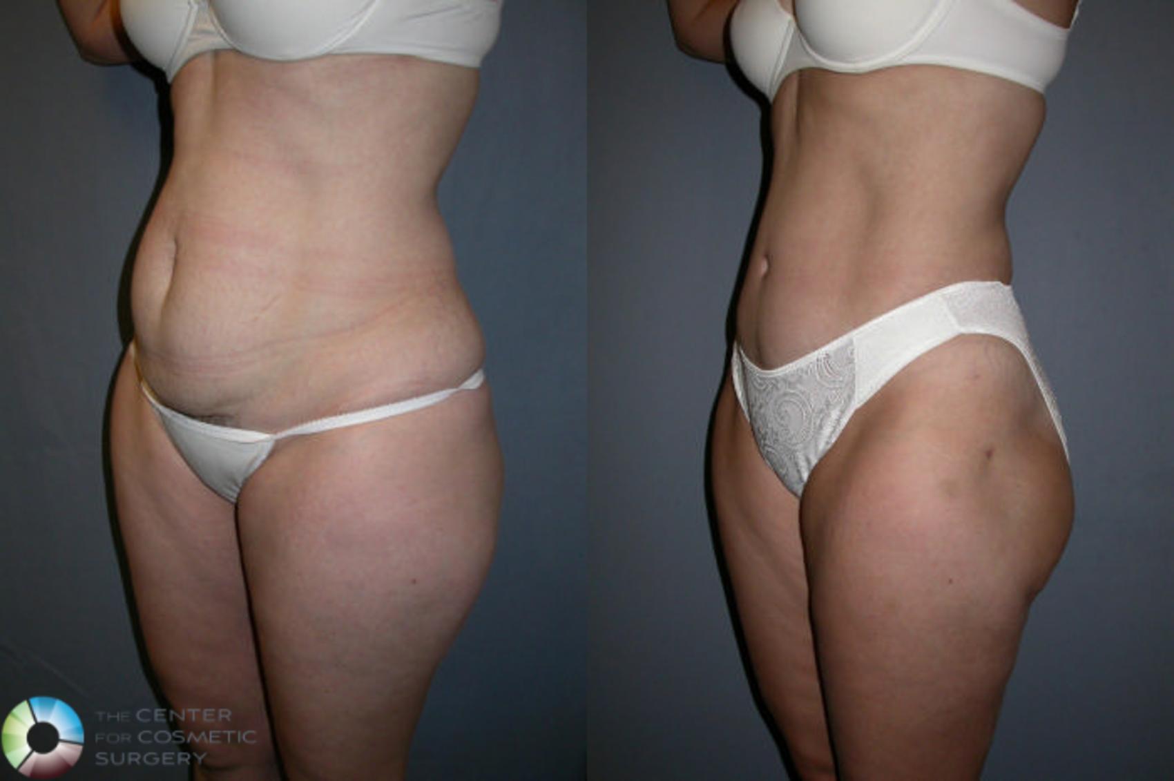 Before & After Tummy Tuck Case 16 View #1 in Denver and Colorado Springs, CO