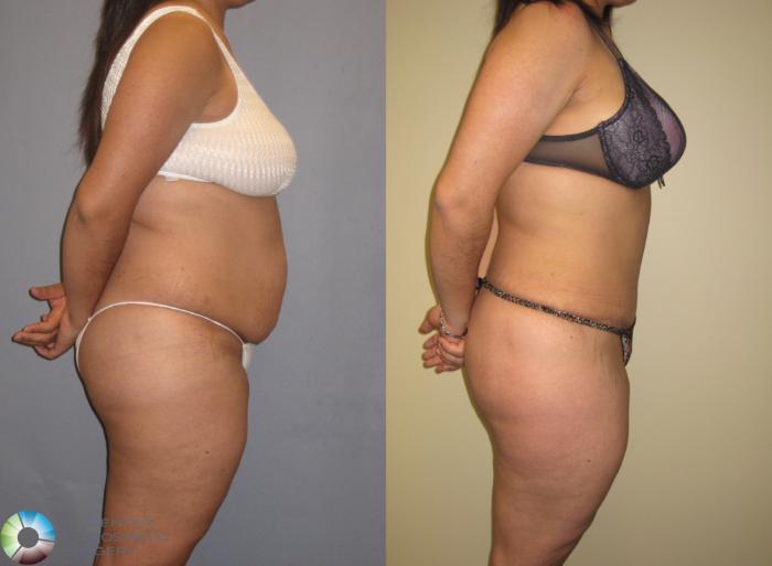 Before & After Tummy Tuck Case 160 View #1 View in Golden, CO