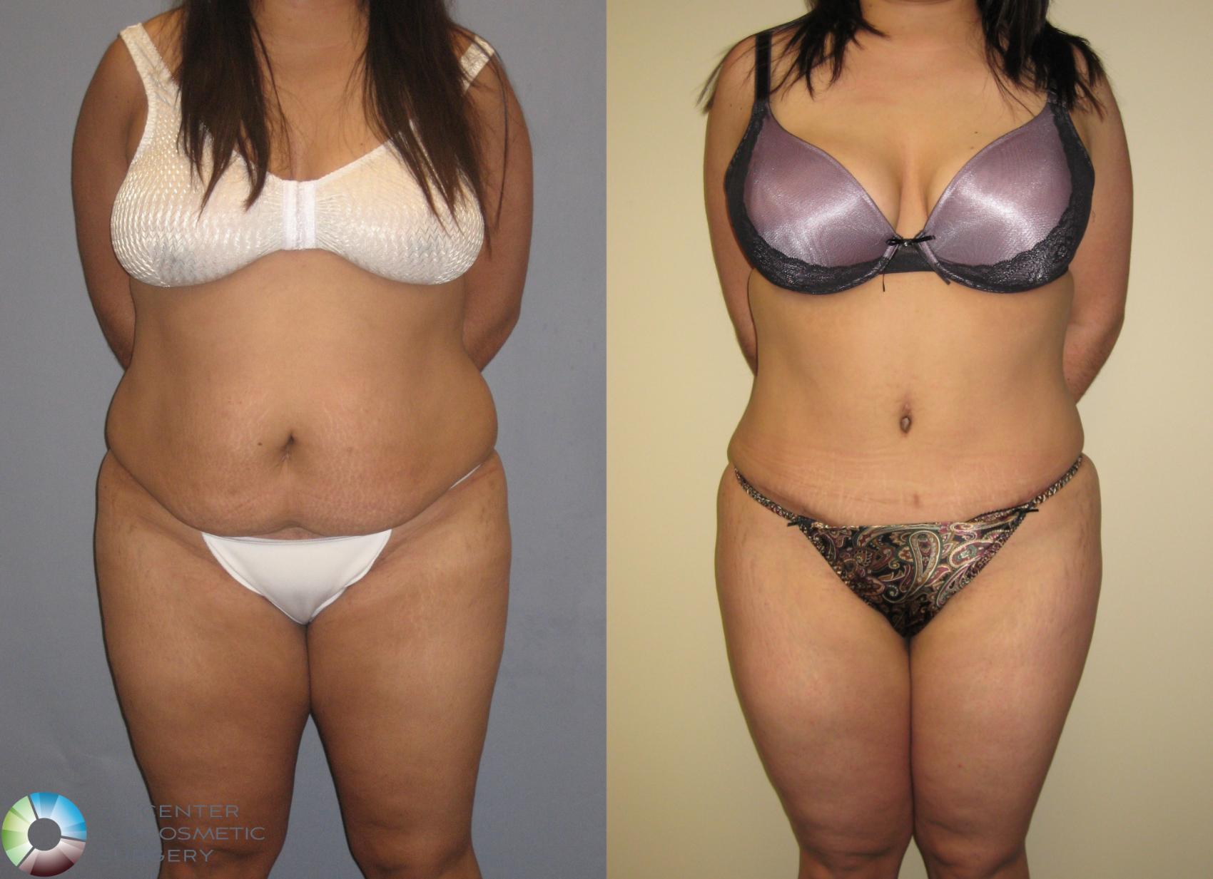 Before & After Tummy Tuck Case 160 View #2 View in Golden, CO